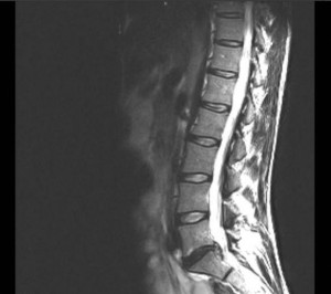 After months of pain, an MRI of Duke’s back revealed her injury, a herniated L5-S1 disc.